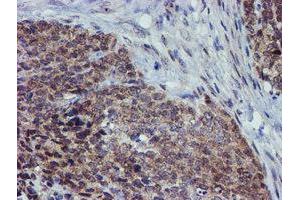 Immunohistochemical staining of paraffin-embedded Adenocarcinoma of Human breast tissue using anti-ALOX15 mouse monoclonal antibody. (ALOX15 anticorps)