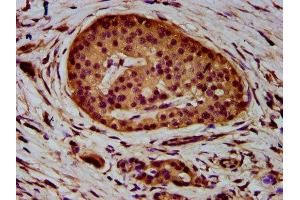 IHC image of ABIN7150047 diluted at 1:400 and staining in paraffin-embedded human pancreatic cancer performed on a Leica BondTM system.