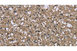 Immunohistochemistry of paraffin-embedded Human prostate cancer using FBP1 Polyclonal Antibody at dilution of 1:40 (FBP1 anticorps)