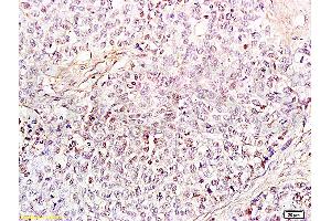 Formalin-fixed and paraffin embedded human endometrium carcinoma labeled Anti-HMGB1 Polyclonal Antibody, Unconjugated (ABIN671616) at 1:200, followed by conjugation to the secondary antibody and DAB staining