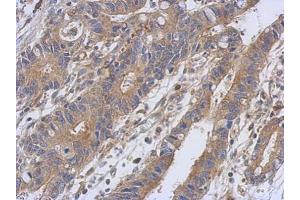 IHC-P Image Immunohistochemical analysis of paraffin-embedded human colon carcinoma, using PKC alpha, antibody at 1:500 dilution. (PKC alpha anticorps  (N-Term))