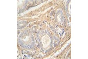 Immunohistochemistry analysis in formalin fixed and paraffin embedded human prostate carcinoma reacted with PCOTH Antibody (Center) followed by peroxidase conjugation of the secondary antibody and DAB staining. (PCOTH anticorps  (Middle Region))