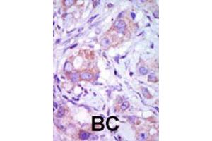 Formalin-fixed and paraffin-embedded human cancer tissue reacted with the MAP3K9 polyclonal antibody  , which was peroxidase-conjugated to the secondary antibody, followed by DAB staining. (MAP3K9 anticorps  (C-Term))