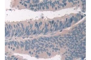 Detection of USP6NL in Human Colorectal cancer Tissue using Polyclonal Antibody to USP6 N-Terminal Like Protein (USP6NL) (USP6NL anticorps  (AA 1-292))