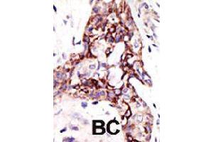 Formalin-fixed and paraffin-embedded human cancer tissue reacted with ARL3 polyclonal antibody  , which was peroxidase-conjugated to the secondary antibody, followed by DAB staining . (ARL3 anticorps  (C-Term))