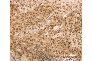 Immunohistochemistry of Human breast cancer using SNX8 Polyclonal Antibody at dilution of 1:25 (SNX8 anticorps)