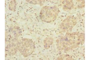 Immunohistochemistry of paraffin-embedded human gastric cancer using ABIN7175005 at dilution of 1:100 (MRPL46 anticorps  (AA 28-153))