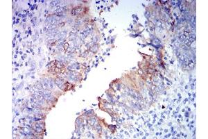 Immunohistochemical analysis of paraffin-embedded rectum cancer tissues using GRIA2 mouse mAb with DAB staining. (GRIA2 anticorps  (AA 35-175))