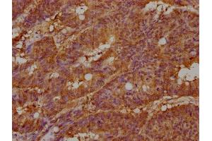 IHC image of ABIN7157186 diluted at 1:100 and staining in paraffin-embedded human colon cancer performed on a Leica BondTM system. (KALRN anticorps  (AA 2410-2661))