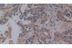 Detection of OPN in Human Breast cancer Tissue using Polyclonal Antibody to Osteopontin (OPN)