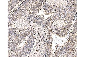 IHC analysis of PAK1 using anti-PAK1 antibody (ABIN7599852).