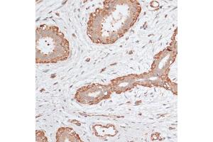 Immunohistochemistry of paraffin-embedded human breast cancer using ABCC5 antibody (ABIN6291734) at dilution of 1:100 (40x lens). (ABCC5 anticorps)