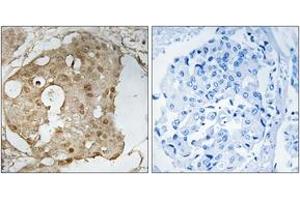 Immunohistochemistry analysis of paraffin-embedded human breast carcinoma, using p53 (Phospho-Ser366) Antibody.