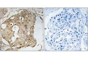 Immunohistochemistry analysis of paraffin-embedded human breast carcinoma, using p53 (Phospho-Ser366) Antibody. (p53 anticorps  (pSer366))