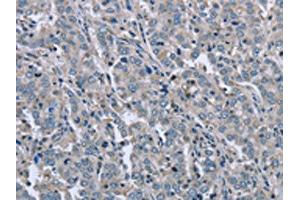 The image on the left is immunohistochemistry of paraffin-embedded Human liver cancer tissue using ABIN7129455(FAR2 Antibody) at dilution 1/50, on the right is treated with fusion protein. (FAR2 anticorps)