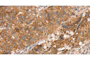 Immunohistochemistry of paraffin-embedded Human breast cancer using PDLIM4 Polyclonal Antibody at dilution of 1:30 (PDLIM4 anticorps)