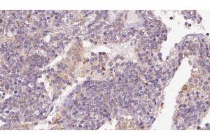 ABIN6273169 at 1/100 staining Human lymph cancer tissue by IHC-P.