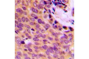 Immunohistochemical analysis of MMP9 staining in human breast cancer formalin fixed paraffin embedded tissue section.