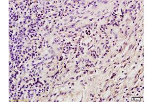 Formalin-fixed and paraffin embedded mouse tumor tissue labeled with Anti SORBS2 Polyclonal Antibody, Unconjugated (ABIN1387807) at 1:200 followed by conjugation to the secondary antibody and DAB staining
