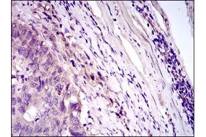 Immunohistochemical analysis of paraffin-embedded esophageal cancer tissues using CD33 mouse mAb with DAB staining. (CD33 anticorps  (AA 15-237))