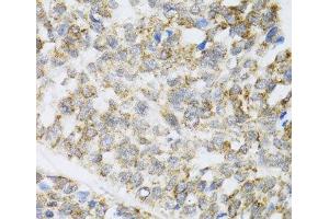 Immunohistochemistry of paraffin-embedded Human esophageal cancer using ZAK Polyclonal Antibody at dilution of 1:100 (40x lens). (ZAK anticorps)