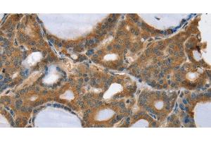Immunohistochemistry of paraffin-embedded Human thyroid cancer using TRIM3 Polyclonal Antibody at dilution of 1:45