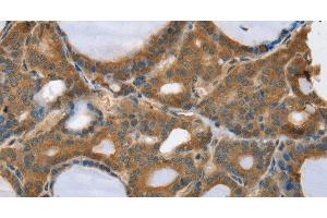 Immunohistochemistry of paraffin-embedded Human thyroid cancer using TRIM3 Polyclonal Antibody at dilution of 1:45 (TRIM3 anticorps)