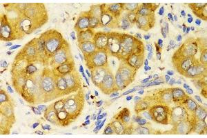 Immunohistochemistry of paraffin-embedded Human liver cancer using LRPAP1 Polyclonal Antibody at dilution of 1:100 (40x lens). (LRPAP1 anticorps)