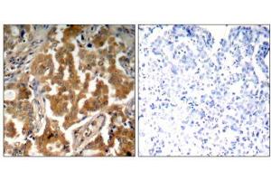 Immunohistochemical analysis of paraffin- embedded human lung carcinoma tissue using ADD1 (Phospho- Ser726) antibody (E011182). (alpha Adducin anticorps  (pSer726))