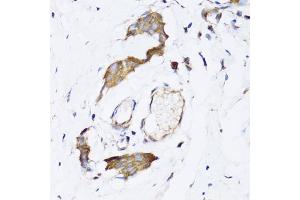 Immunohistochemistry of paraffin-embedded human breast cancer using NAA10 antibody (ABIN5974216) at dilution of 1/100 (40x lens).