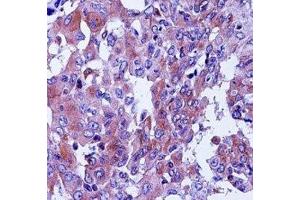 CD55 antibody immunohistochemistry analysis in formalin fixed and paraffin embedded human lung adenocarcinoma.
