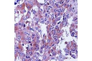 CD55 antibody immunohistochemistry analysis in formalin fixed and paraffin embedded human lung adenocarcinoma. (CD55 anticorps  (AA 51-79))
