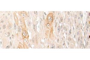 Immunohistochemistry of paraffin-embedded Human esophagus cancer tissue using DDX24 Polyclonal Antibody at dilution of 1:35(x200) (DDX24 anticorps)