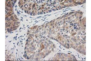 Immunohistochemical staining of paraffin-embedded Adenocarcinoma of Human breast tissue using anti-TOMM34 mouse monoclonal antibody. (TOMM34 anticorps)