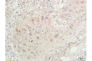 Formalin-fixed and paraffin embedded human oral squamous cell carcinoma labeled with Anti- PCNA-Proliferation Marker Polyclonal Antibody, Unconjugated  at 1:100 followed by conjugation to the secondary antibody and DAB staining (PCNA anticorps  (AA 151-261))
