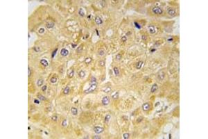 IHC analysis of FFPE human hepatocarcinoma tissue stained with Integrin linked kinase antibody (ILK anticorps  (AA 11-41))