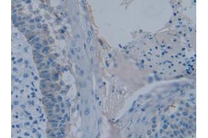 DAB staining on IHC-P; Samples: Human Skin cancer Tissue (PLAA anticorps  (AA 367-468))