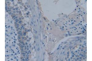 DAB staining on IHC-P; Samples: Human Skin cancer Tissue