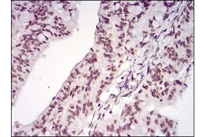 Immunohistochemical analysis of paraffin-embedded rectum cancer tissues using MEN1 mouse mAb with DAB staining.