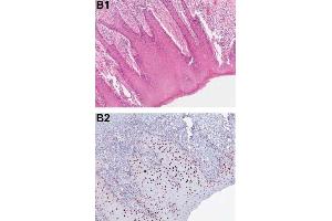 Immunohistochemical analysis of PDCD4 shows the corresponding H&E-stained and PDCD4-stained tissue sections from patients with OSCC.