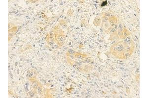 ABIN7095788 and ABIN7099850 at 1/100 staining human tongue carcinoma by IHC-P. (MEG3 anticorps)