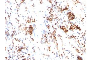 Formalin-fixed, paraffin-embedded human Colon Cancer stained with p27 Monoclonal Antibody (DCS-72. (CDKN1B anticorps)