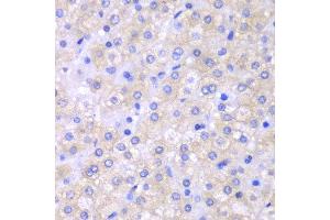 Immunohistochemistry of paraffin-embedded human liver cancer using SH2D1A antibody at dilution of 1:100 (400x lens). (SH2D1A anticorps)