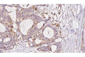 ABIN6273046 at 1/100 staining Human liver cancer tissue by IHC-P. (FAF2 anticorps  (Internal Region))