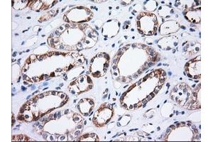 Immunohistochemical staining of paraffin-embedded Adenocarcinoma of Human ovary tissue using anti-TTC32 mouse monoclonal antibody. (TTC32 anticorps)