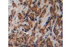IHC-P analysis of breast cancer tissue, with DAB staining. (Fibrillin 2 anticorps  (AA 1550-1791))
