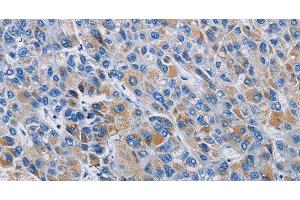 Immunohistochemistry of paraffin-embedded Human liver cancer tissue using RICTOR Polyclonal Antibody at dilution 1:50 (RICTOR anticorps)