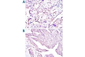 Immunohistochemical analysis of paraffin-embedded human placenta tissues (A) and ovarian cancer (B) using E7 monoclonal antibody, clone 6F3  with DAB staining. (HPV16 E7 anticorps)