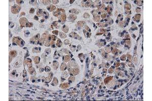 Immunohistochemical staining of paraffin-embedded Adenocarcinoma of Human colon tissue using anti-CDCP1 mouse monoclonal antibody. (CDCP1 anticorps)