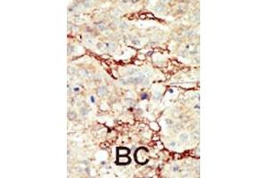 Formalin-fixed and paraffin-embedded human cancer tissue reacted with the primary antibody, which was peroxidase-conjugated to the secondary antibody, followed by DAB staining.